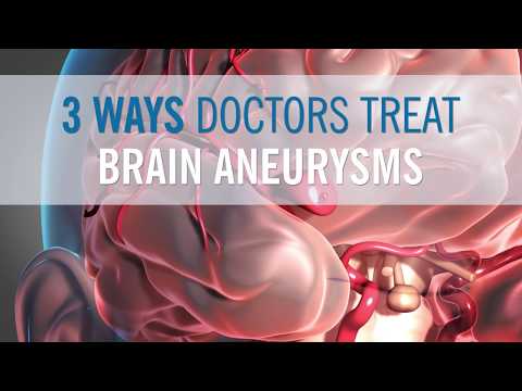 3 Ways Doctors Can Treat Your Brain Aneurysm Youtube