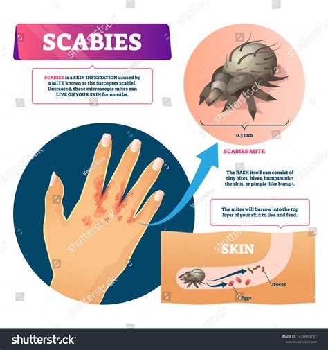 4 543 Scabies Images Stock Photos Vectors Shutterstock