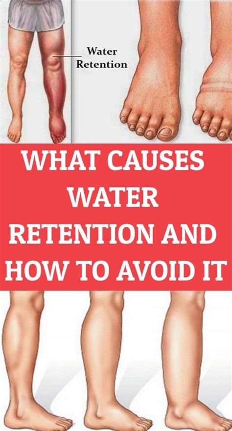 5 Reasons Your Body Retains Water And How To Avoid It Water Retention Health Diy Health