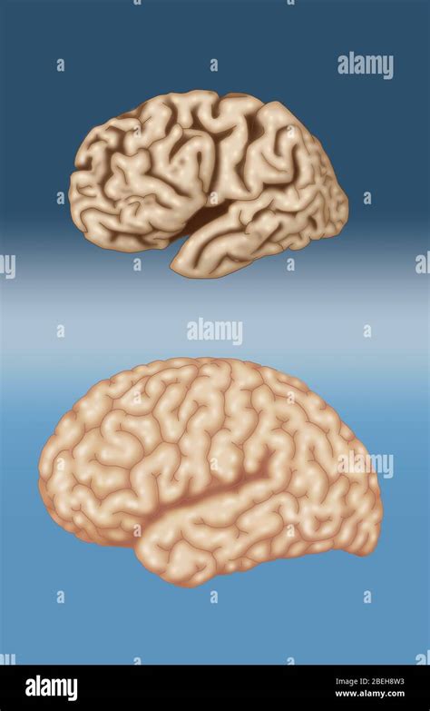 Alzheimer Brain Comparison Hi Res Stock Photography And Images Alamy