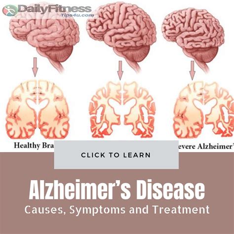 Alzheimer Disease Causes Symptoms Treatment And Frequently Asked