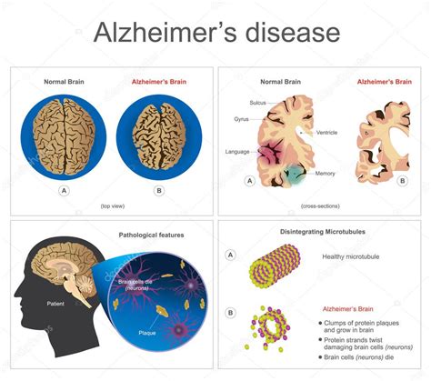 Alzheimer S Disease Byhealth Com