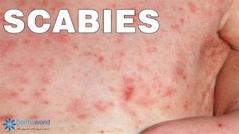 Best Scabies Doctor In Delhi India Scabies Treatment Cost In Delhi