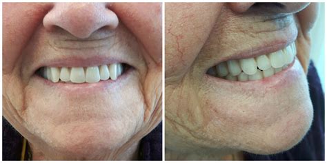 Complete Upper Lower Dentures Kelowna Denture Clinic