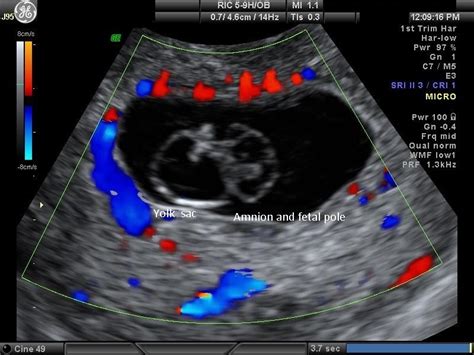 Diagnostic Ultrasound In The First Trimester Of Pregnancy Glowm