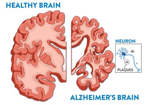 Difference Between A Healthy Brain And Alzheimer S Disease Brain