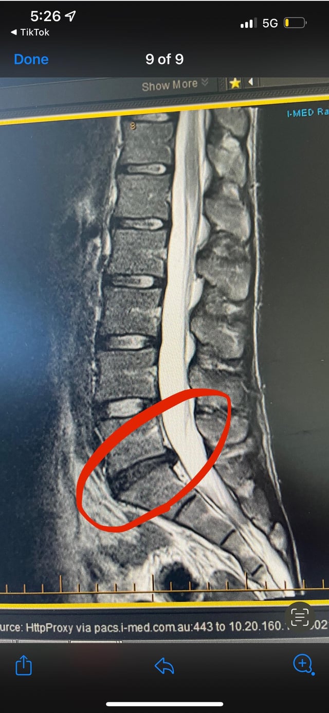 Doctor Ruled Out Herniated Disc Through Xray R Backpain