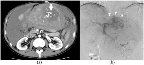 Enhanced Ct Imaging And Angiography At The Time Of Hcc Rupture A The Download Scientific