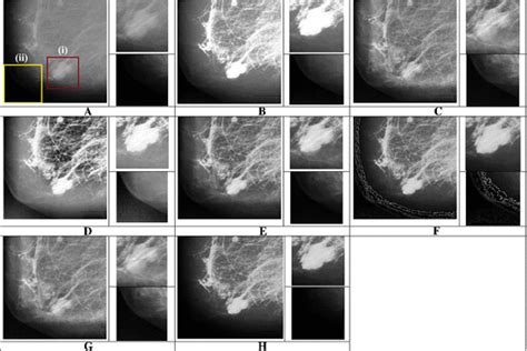 Enhancement Results For A Mammogram Image Patch Cropped From Fatty