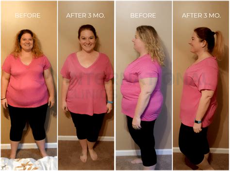 Gastric Sleeve Before And After In St Louis St Louis Bariatrics