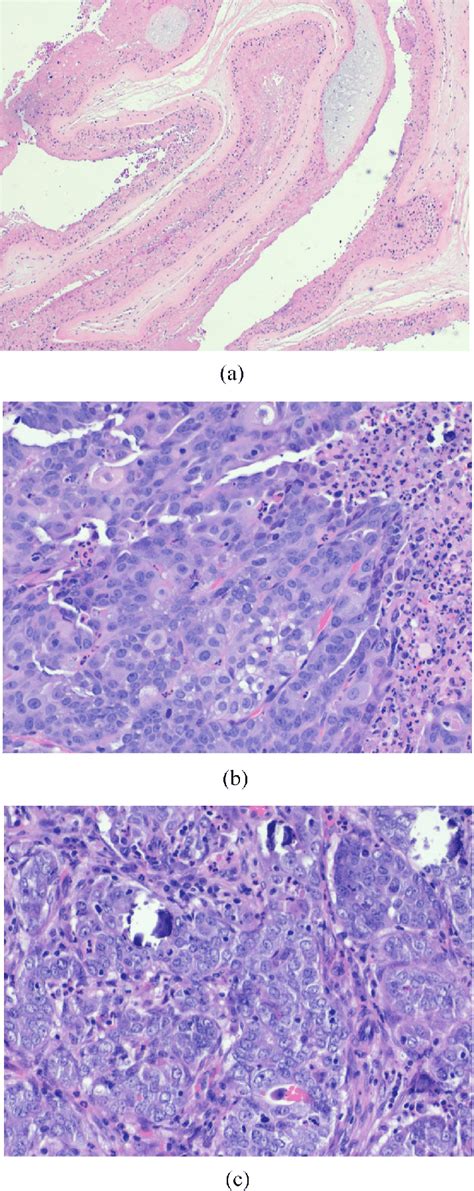 Histopathology Demonstrating A Retained Products Of Conception B