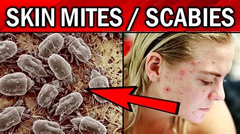 How To Get Rid Of Skin Mites Youtube