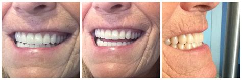 Immediate Complete Upper Amp Lower Dentures Kelowna Denture Clinic