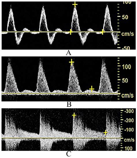 Interpretation Of Peripheral Arterial And Venous Doppler, 48% Off