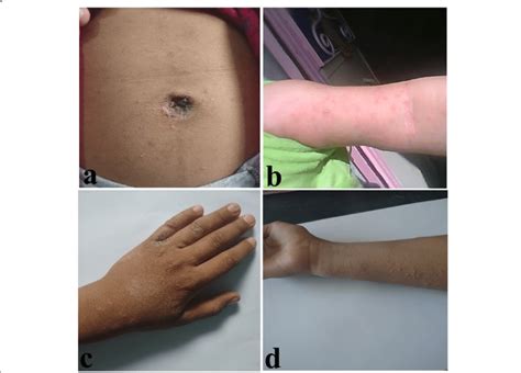 Locations Of Scabies Infestation In Schoolchildren Of Bashagard County