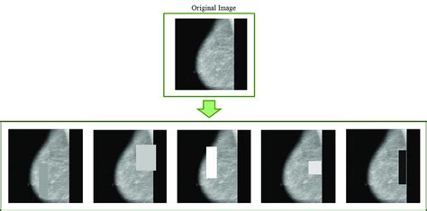 Mammograms After Applying Random Erasing Download Scientific Diagram