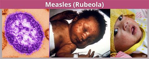 Measles Rubeola Benton Franklin Health District