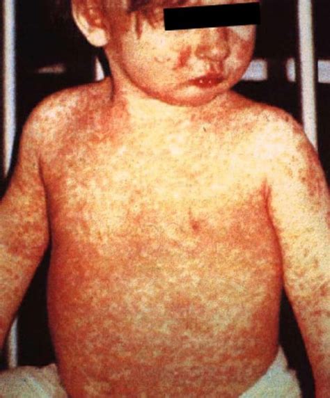 Measles Rubeola Cdc