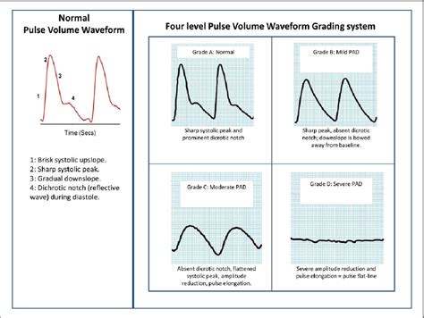 Non Invasive Assessment Of Peripheral Arterial Disease Automated Ankle