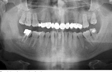 Pdf Peripheral Calcifying Odontogenic Cyst A Rare Case Report Calcifying Odontogenic Cyst