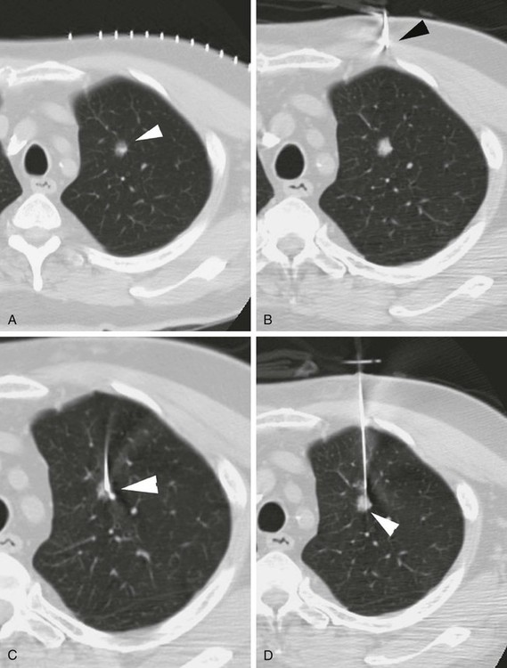 Percutaneous Biopsy Radiology Key