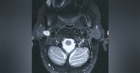 Pleomorphic Adenoma Registered Dental Hygienists