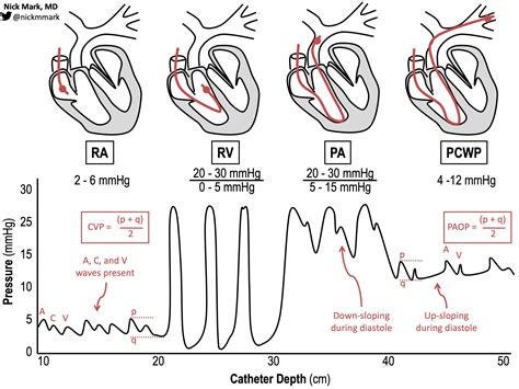 Pulmonary Artery Pa Catheter Waveforms Explained Youtube