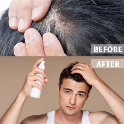 Remove Mites For Healthier Hair Pressreader