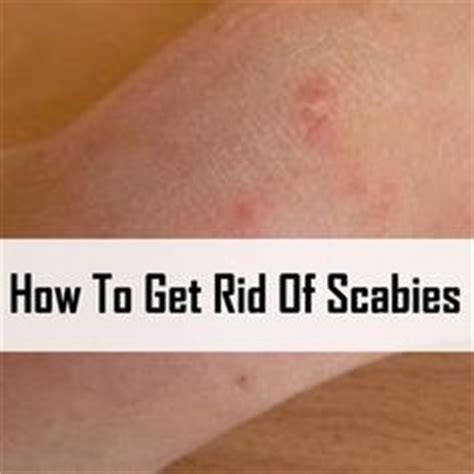 Scabies Is Something That You Don T Hear Much About Anymore Due To Better Hygiene And Mode