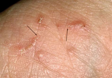 Scabies Skin Deep