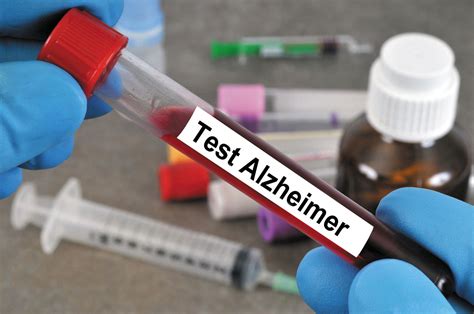 Simple Blood Test May Be Able To Diagnose Alzheimer S Disease Uc San