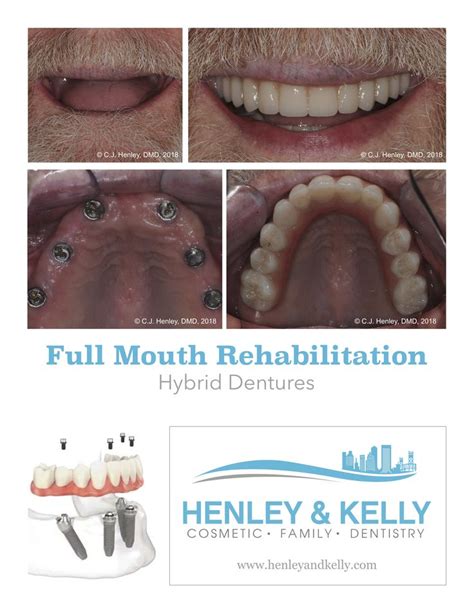 Simply Better Dentistrycase Of The Month Screw Retained Dentures