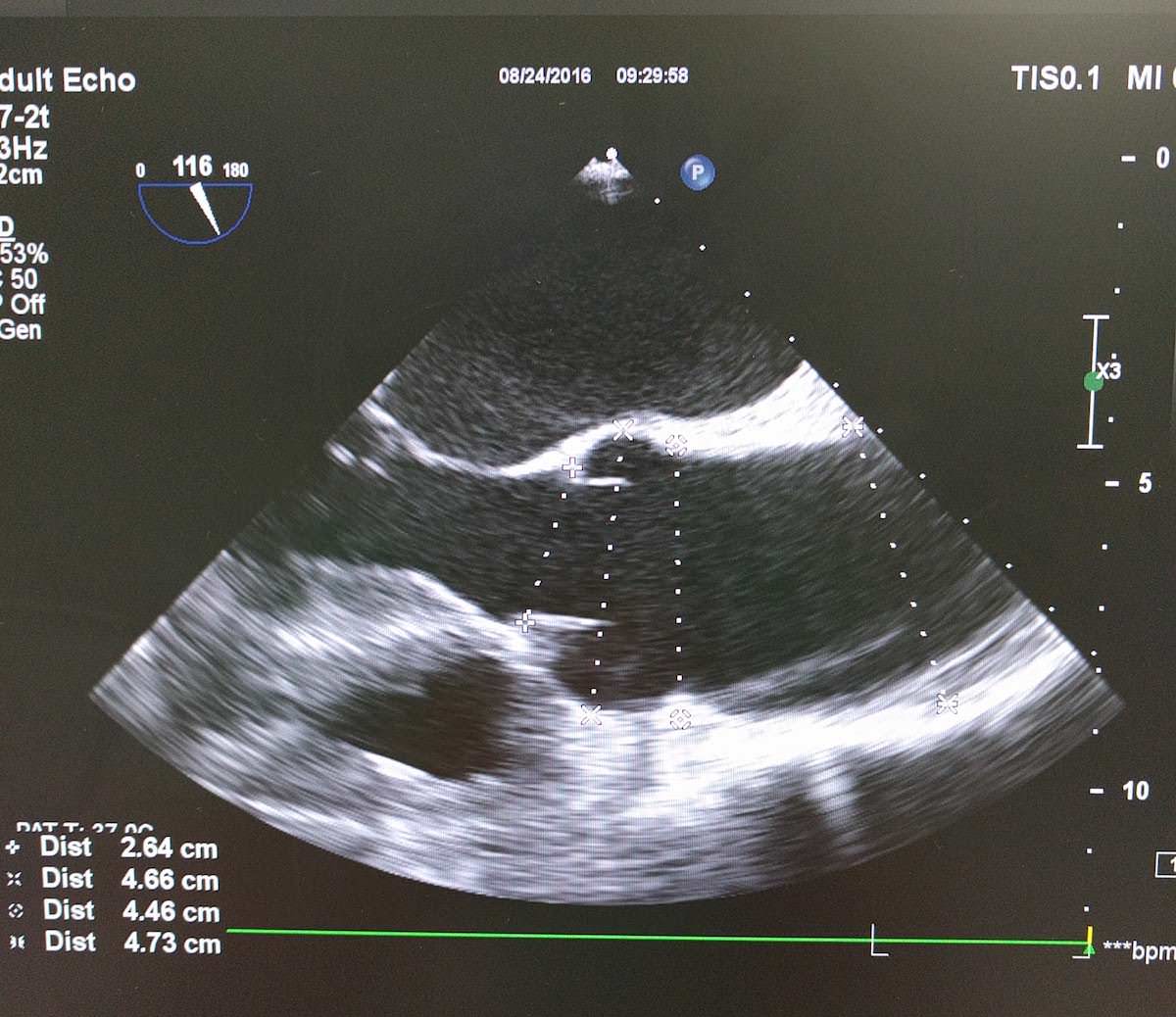 Surgical Steps In Coronary Artery Bypass Grafting Cabg Rk Md