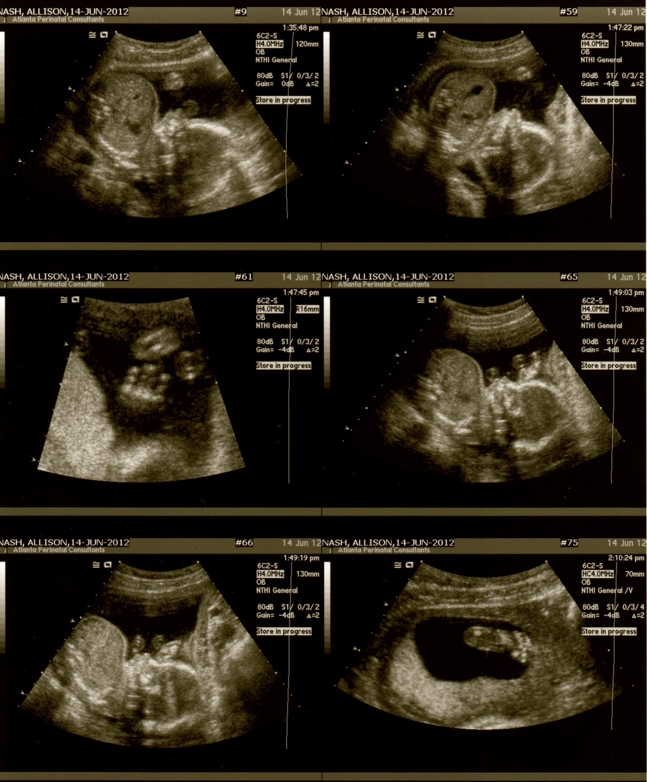 Sweet Baby Nash 20 Week Anatomy Scan