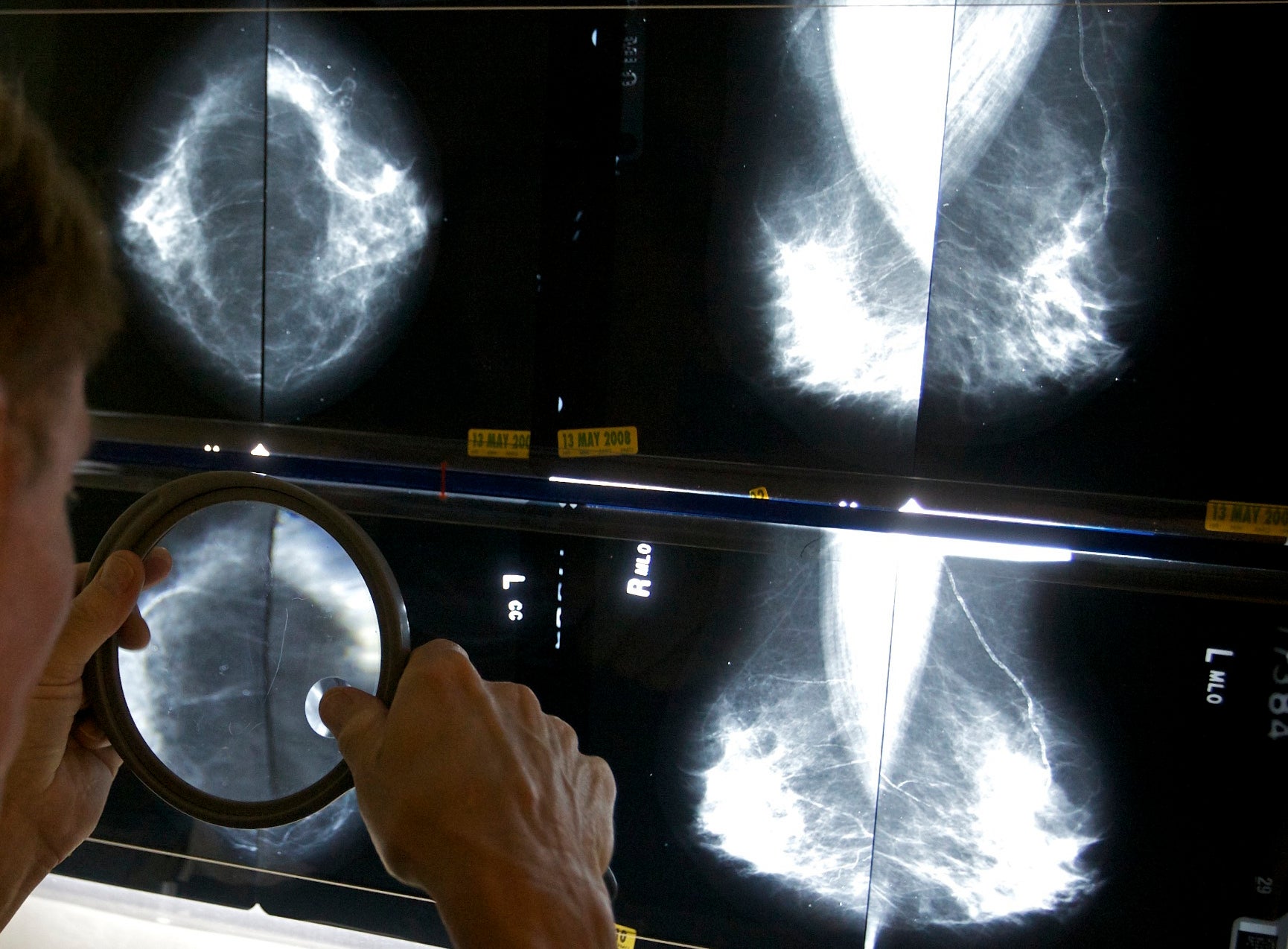 Us To Require Breast Density Information After Mammograms