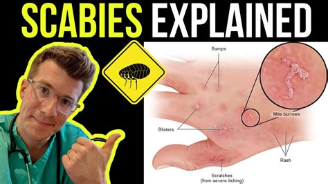 What Are Scabies How Are They Caused How To Cure Them Youtube