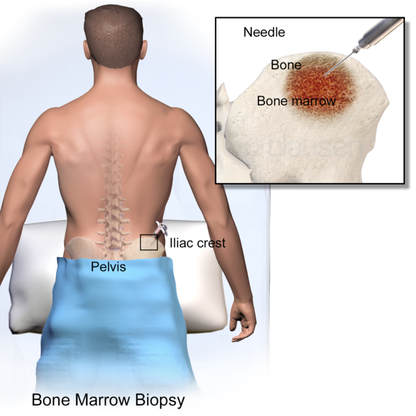 What Is A Bone Marrow Biopsy Procedure Recovery Side Effects