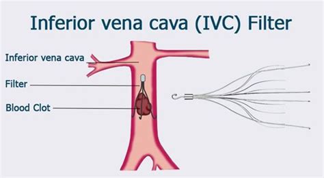 What Is Ivc Filter