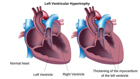 5 LVH Paperwork Tips