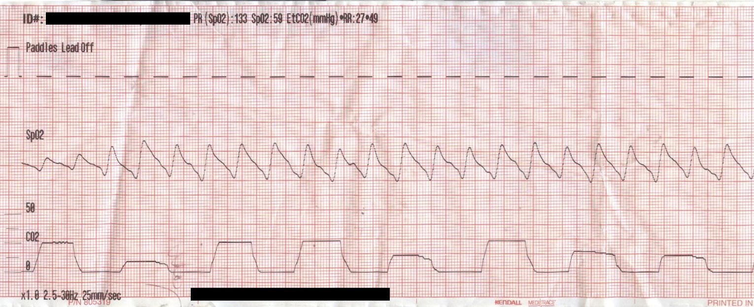 Cardiac Wheeze Paperwork Explained